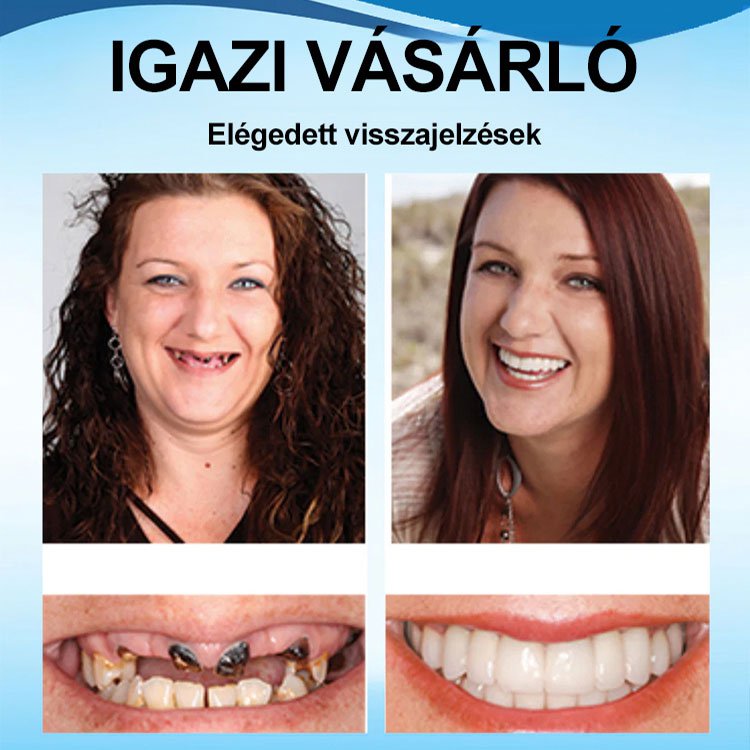 Tökéletes Mosoly Fogpótlás Készlet