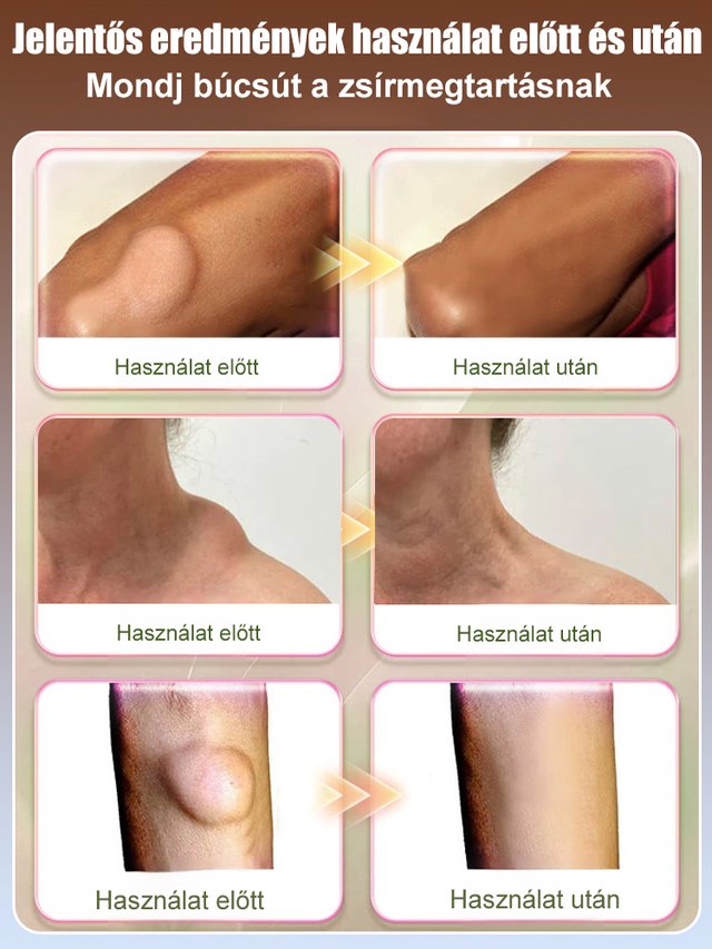 【Egy kenet és nem újul ki】Hét nap alatt eltünteti a lipómákat kenőcs