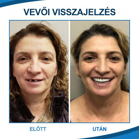 ORALHOE Fogmódosító fogsor fogszabályozó