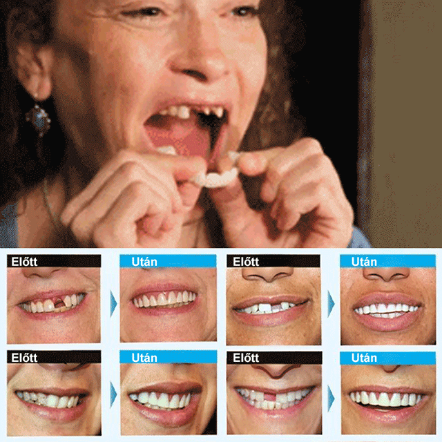 Tökéletes Mosoly Fogpótlás Készlet