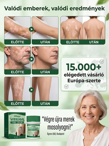 Fehér foltok azonnali eltüntetése, hormonmentes orvosi bőrápoló krém