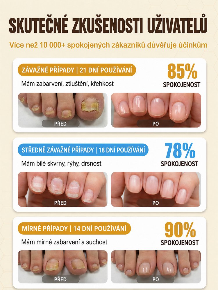 【7 nap a tiszta körmökért】Méhméreg körömápoló cseppek