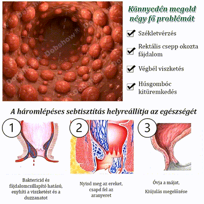 【Orvosi minőségű, 3 napos aranyér elleni kezelés】Fájdalommentes anális ápoló spray
